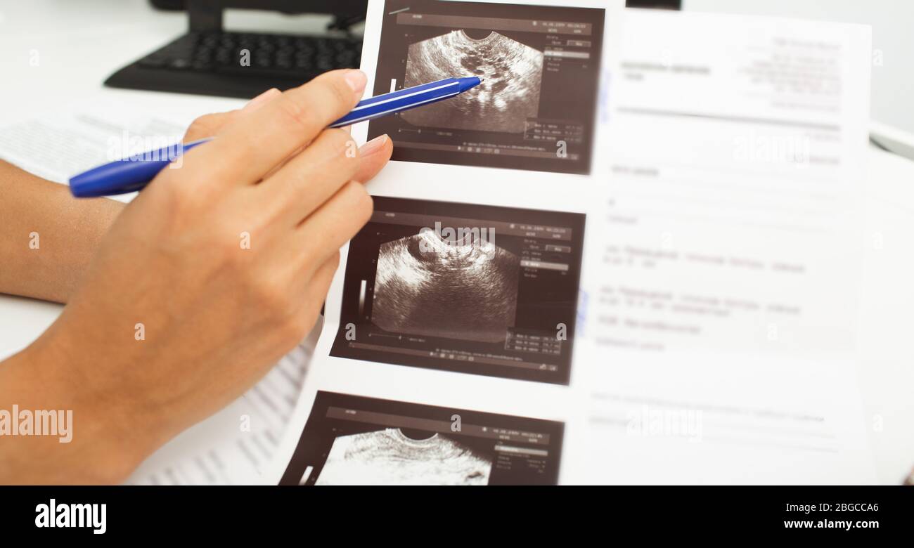 gynécologie, résultats de folliculométrie. Planification de grossesse, follicule dominant. Surveillance de l'ovulation Banque D'Images