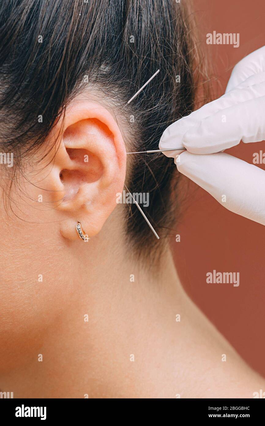 Traitement de nombreuses maladies par acupuncture de l'oreille
