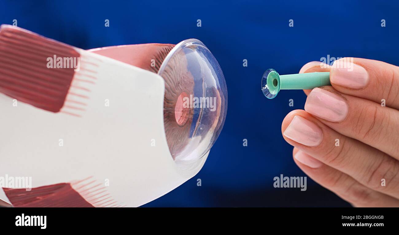 Modèle oculaire et lentille de contact dans la main de l'optométriste sur fond bleu. Correction de la vision à l'aide de lentilles de contact Banque D'Images