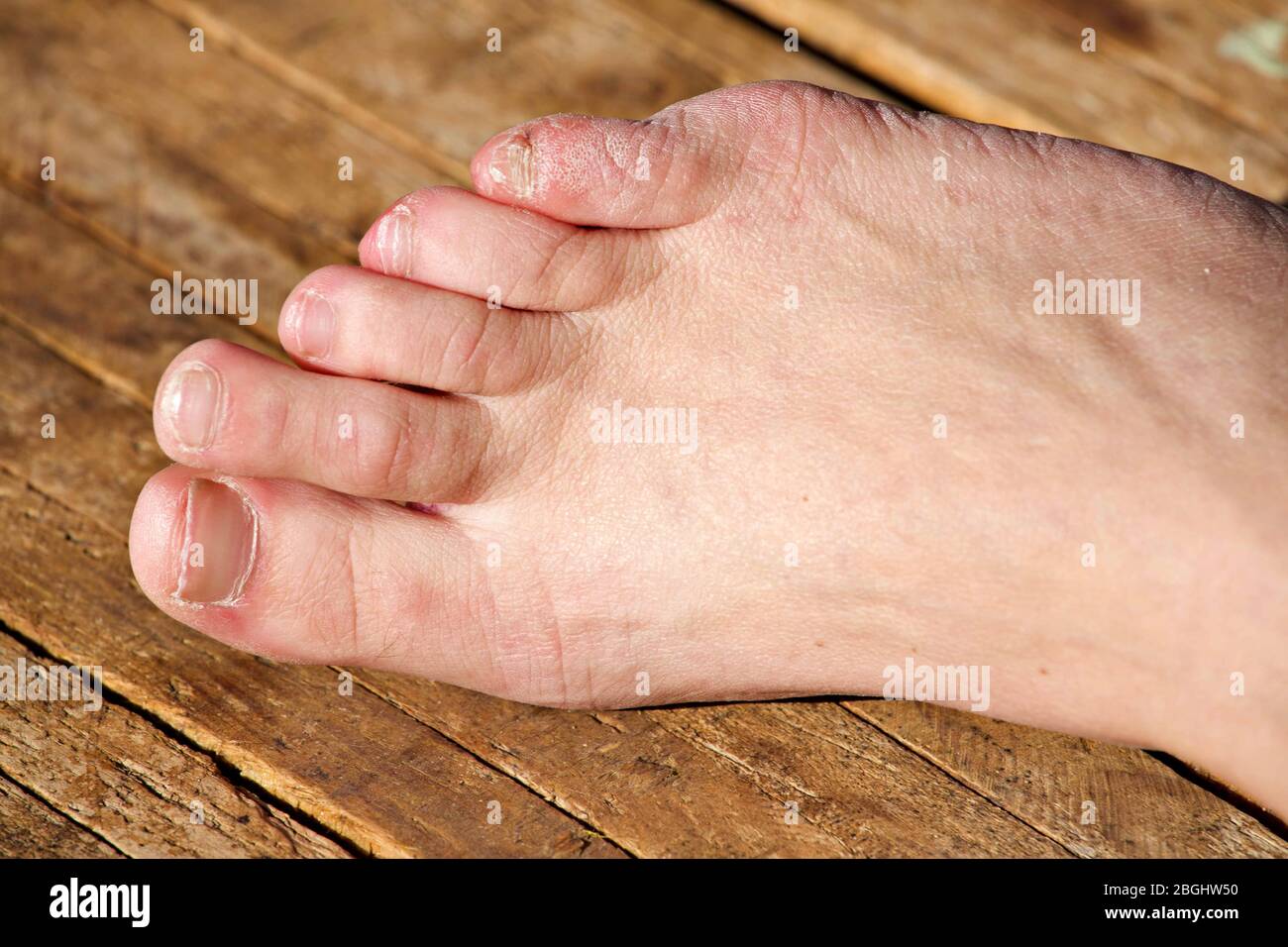 Ampoules aux pieds Banque de photographies et d’images à haute résolution Alamy