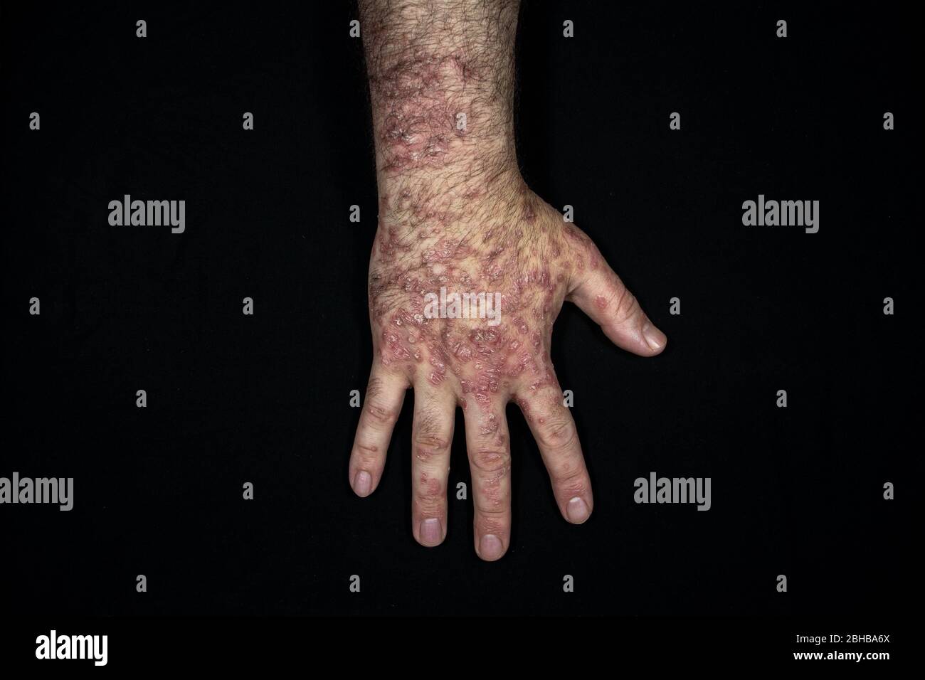 Le psoriasis (eczéma) de la main isolé sur fond noir Banque D'Images Le psoriasis (eczéma) de la main isolé sur fond noir Banque D'Images