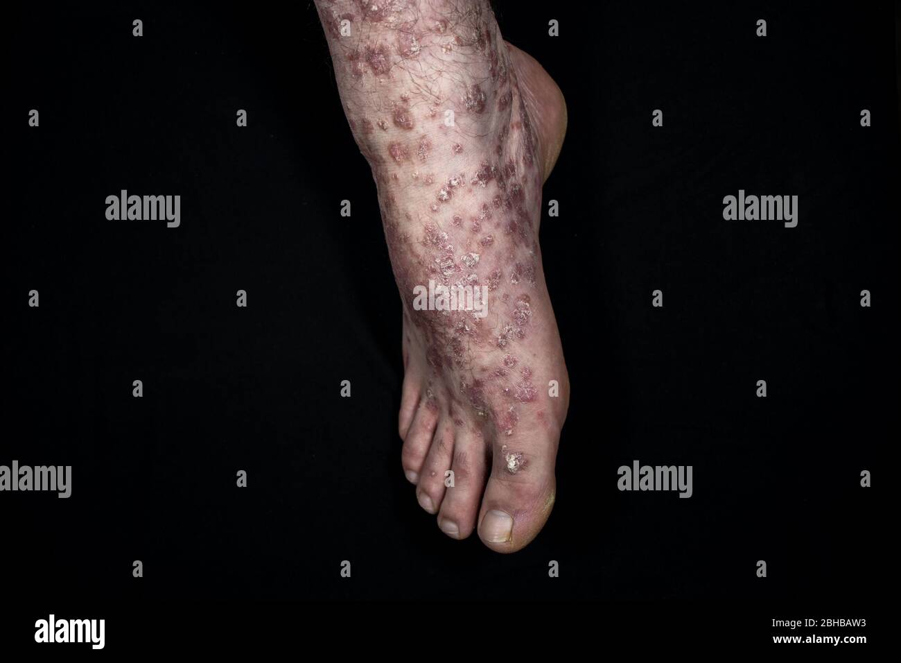 Psoriasis (eczéma) à pied isolé sur fond noir Banque D'Images
