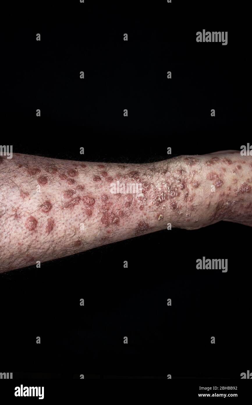 Psoriasis (eczéma) à pied isolé sur fond noir Banque D'Images