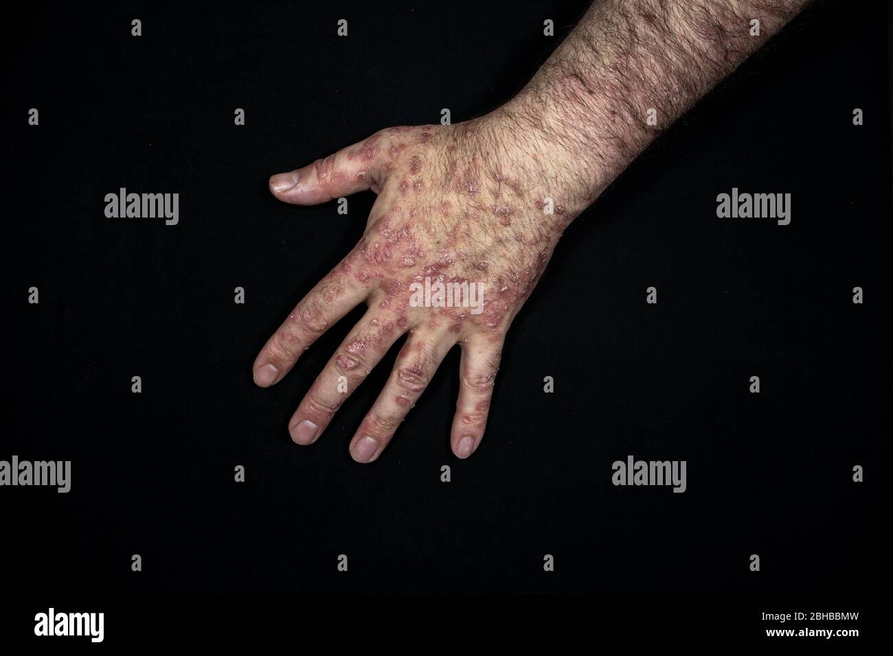 Le psoriasis (eczéma) de la main isolé sur fond noir Banque D'Images Le psoriasis (eczéma) de la main isolé sur fond noir Banque D'Images
