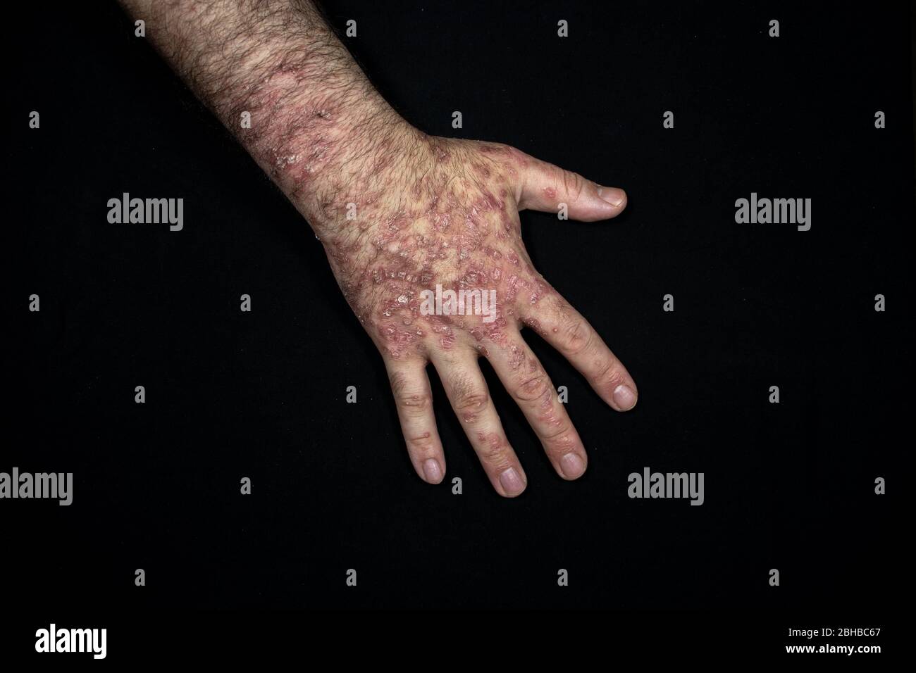Le psoriasis (eczéma) de la main isolé sur fond noir Banque D'Images Le psoriasis (eczéma) de la main isolé sur fond noir Banque D'Images