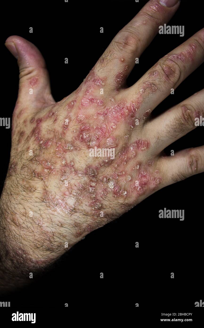 Le psoriasis (eczéma) de la main isolé sur fond noir Banque D'Images Le psoriasis (eczéma) de la main isolé sur fond noir Banque D'Images