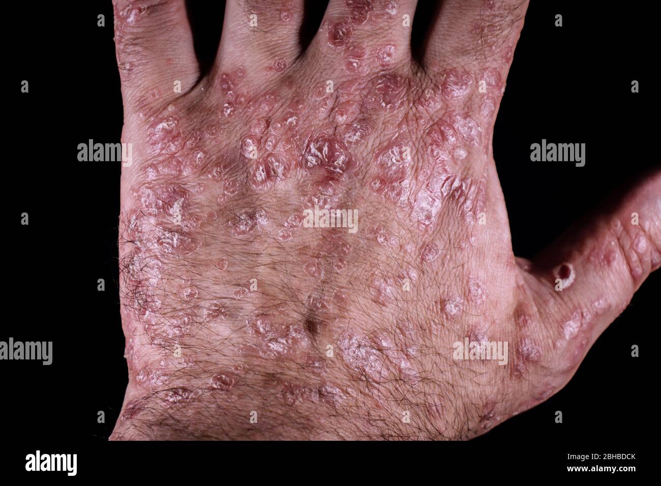 Le psoriasis (eczéma) de la main isolé sur fond noir Banque D'Images Le psoriasis (eczéma) de la main isolé sur fond noir Banque D'Images