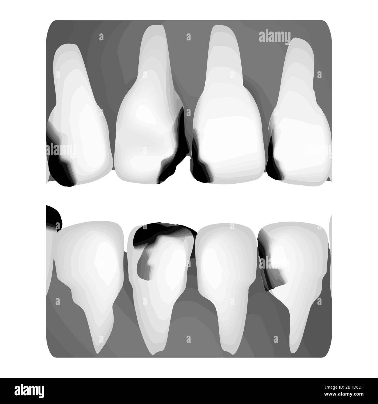 Caries dentaires. Rayons X de la carie dentaire. Infos sur les caries. Illustration vectorielle sur un arrière-plan isolé. Illustration de Vecteur