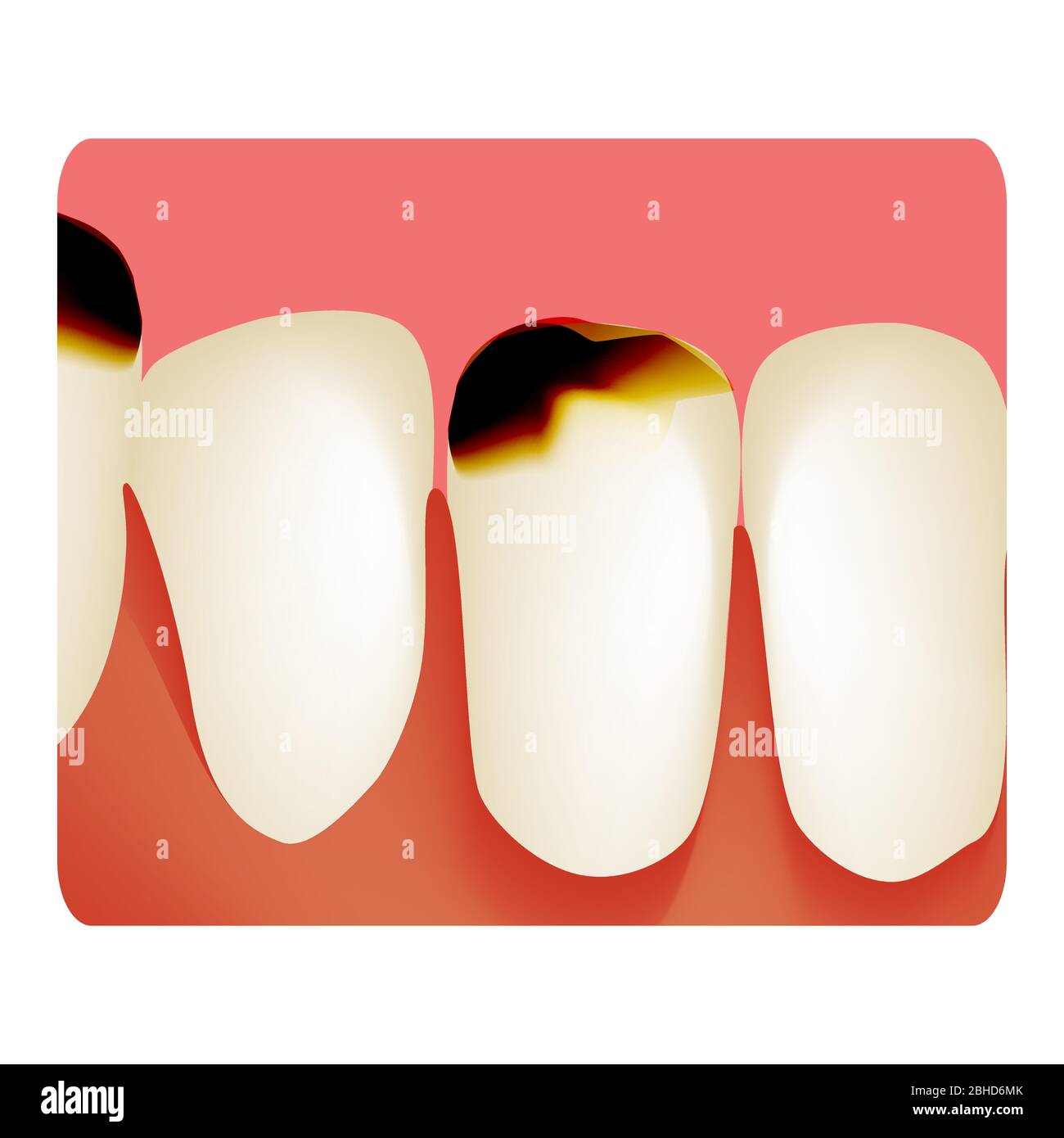 Caries dentaires. Carie dentaire. Infos sur les caries. Illustration vectorielle sur un arrière-plan isolé. Illustration de Vecteur