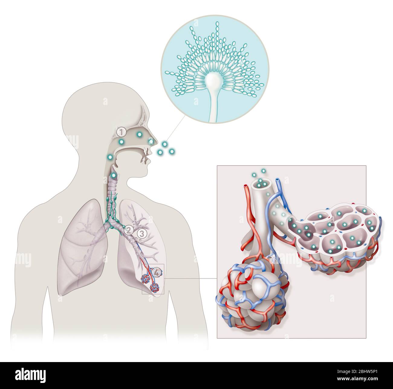 Les 4 principaux types de maladie d'aspergillose.ces infections sont causées par l'inhalation des spores d'un petit champignon appelé aspergillus, le plus souvent asper Banque D'Images