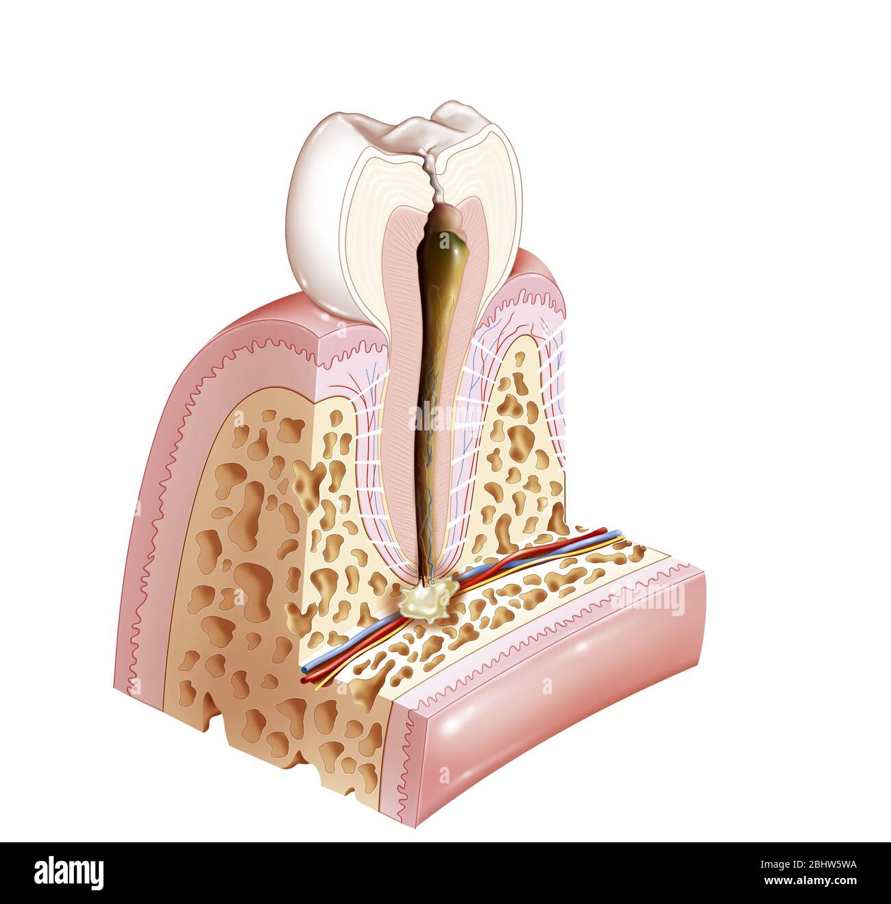 L'abcès apical des dents est lié au développement des cavités. Il s'agit d'une implication alvéolaire osseuse située en contact avec l'apex dentaire avec le for Banque D'Images