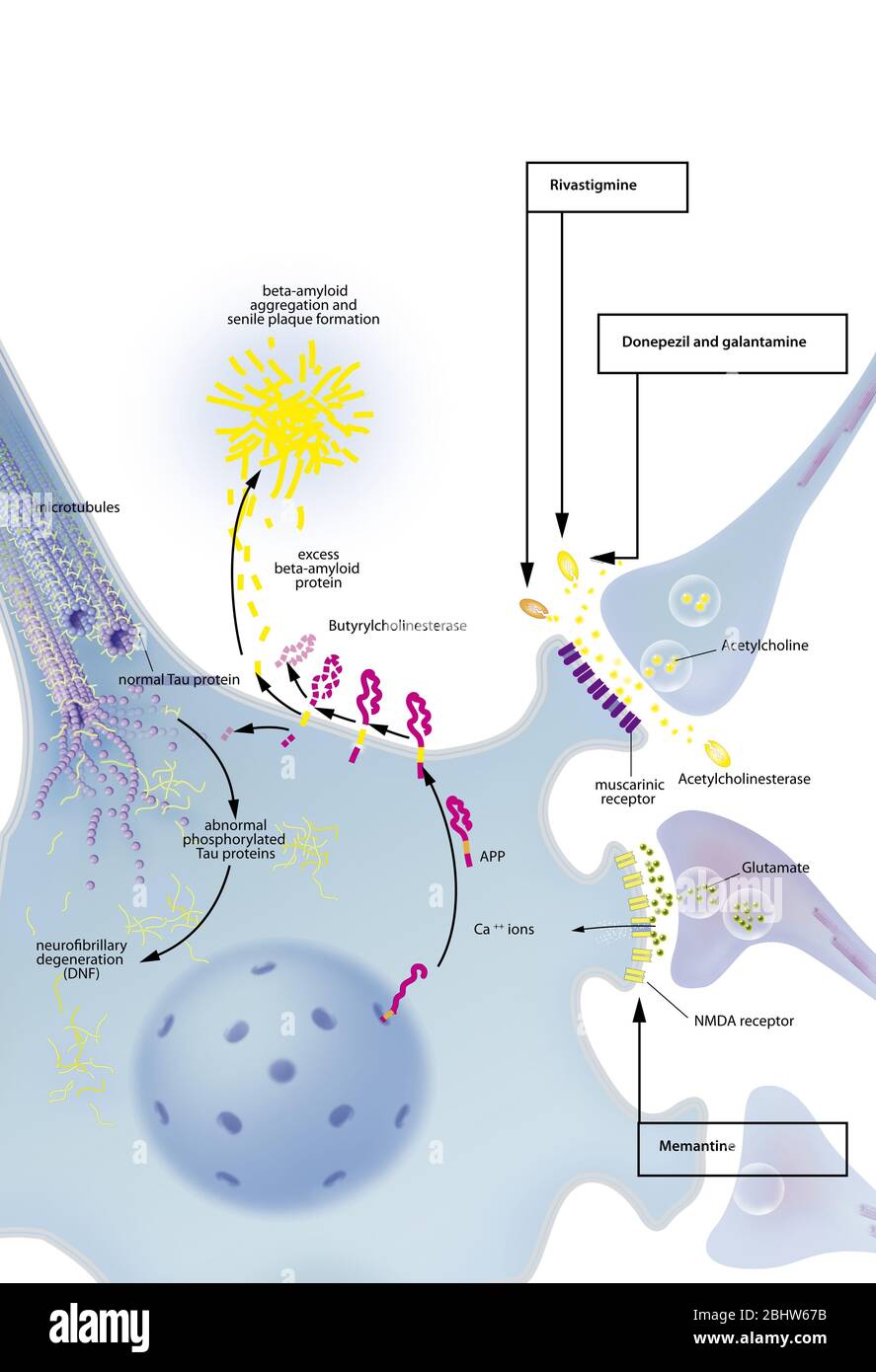 Processus de dégénérescence neurofibrillaire avec neurone, plaque sénile, des traitements. Neurone dans le système nerveux central affectées par clivage anormal de l'APP Banque D'Images