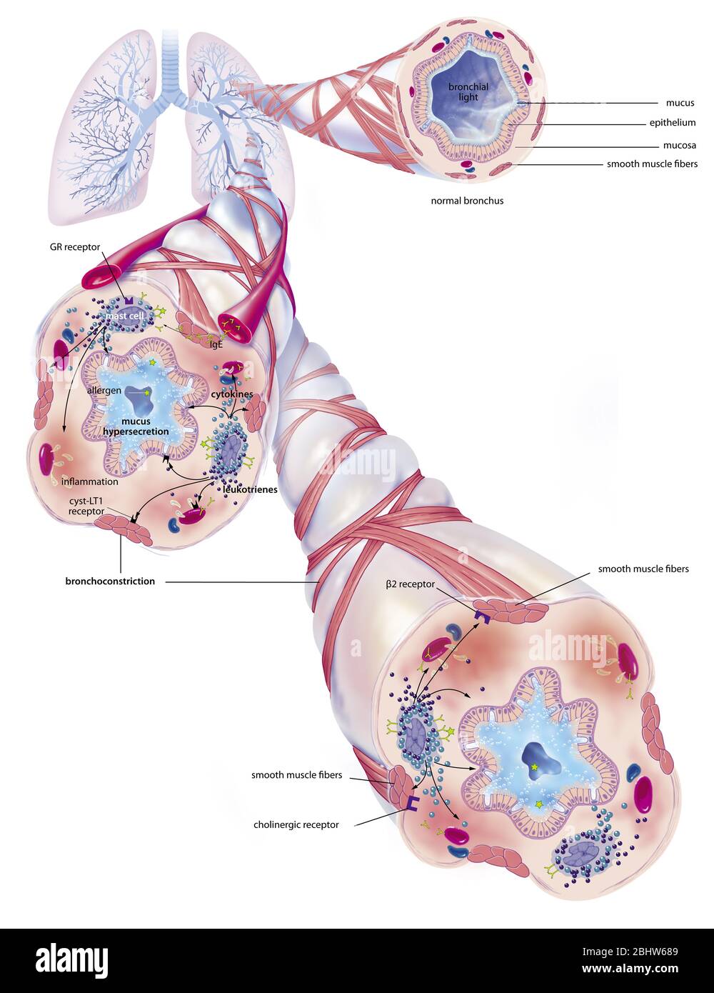 Asthme et ses traitements. Représentation des poumons avec l'arbre bronchique à partir duquel 3 zooms partent. Au-dessus de la gauche, une bronchiole saine, en dessous, deux Banque D'Images