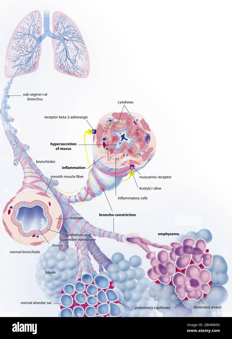 La MPOC La maladie pulmonaire obstructive chronique et ses traitements. Dans le coin supérieur gauche, les poumons avec l'arbre bronchique dans la transparence, d'où une sous-segme Banque D'Images