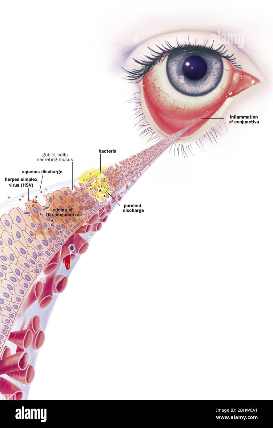 Conjonctivite infectieuse et ses traitements. Vue d'un oeil avec inflammation de la conjonctive. Zoom sur la conjonctive avec de haut en bas 1 b Banque D'Images