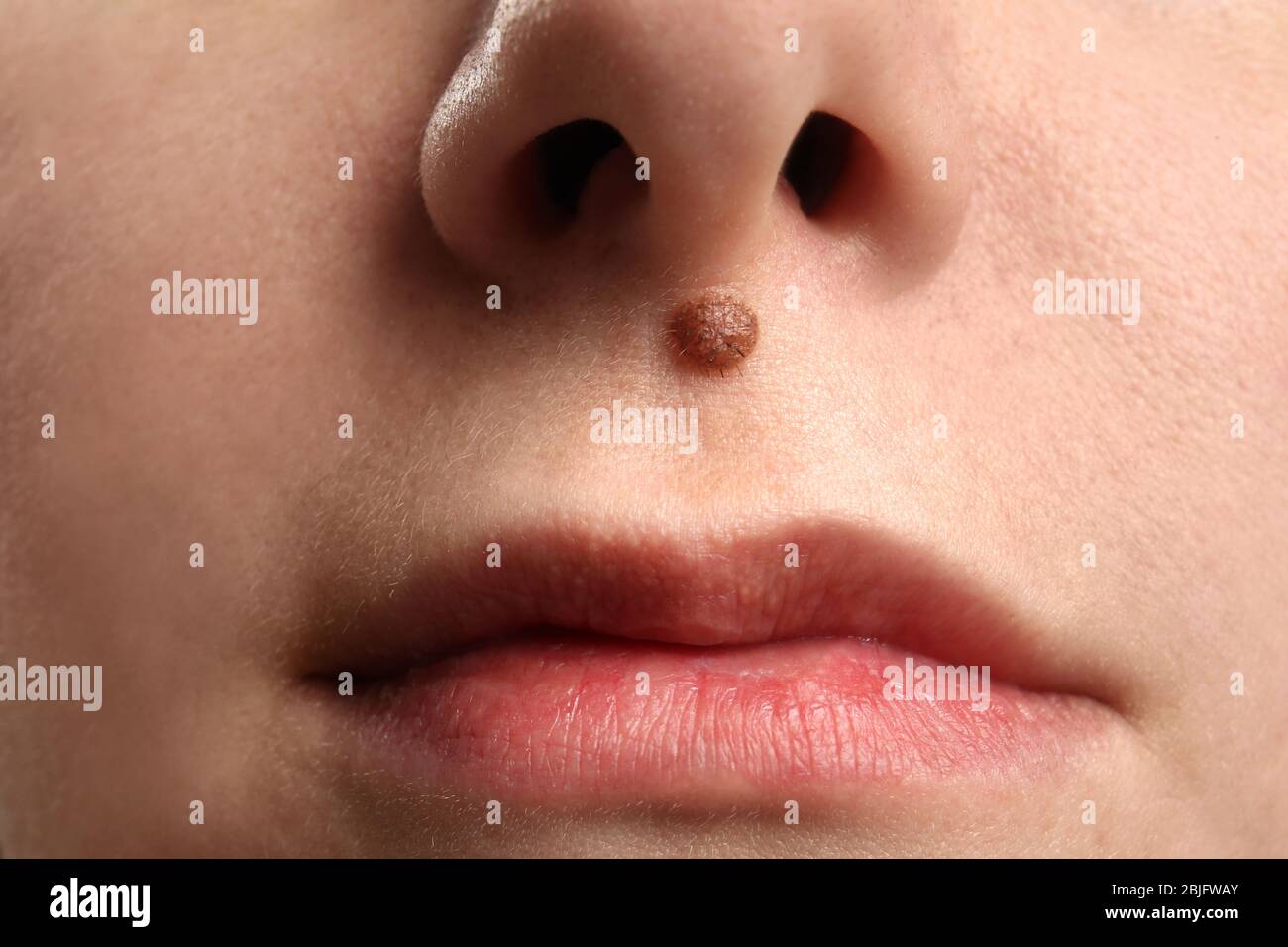 Marque de naissance sur le visage de la jeune femme, clôture Banque D'Images