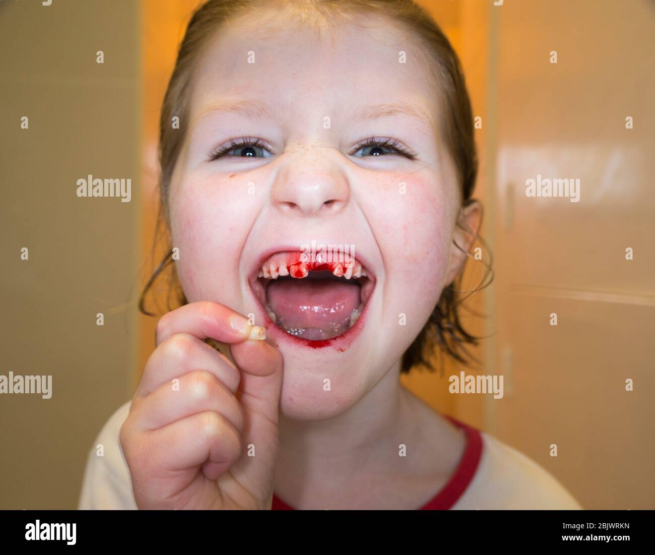 Une petite fille de cinq ans qui est heureuse et ravie, ayant tiré une de  ses dents de lait, une incisive de dessus lâche. La plaie est en train de  saigner avec