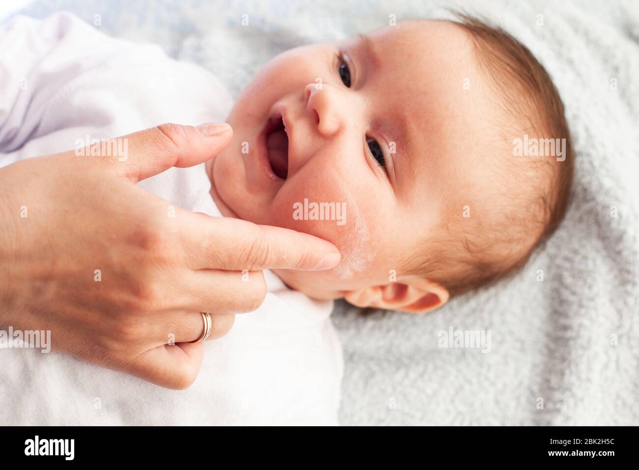 Bebe Avec Dermatite Atopique Obtenir Creme Mettre Soins Et Prevention De L Eczema Gardez Votre Bebe A L Ecoute Photo Stock Alamy