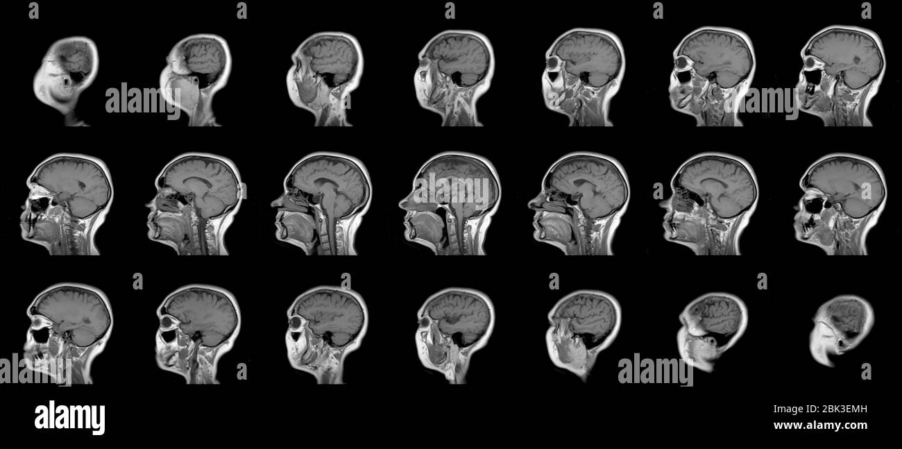 Ensemble d'examens IRM série de 60 ans de race blanche tête femelle dans le plan sagittal ou longitudinal Banque D'Images