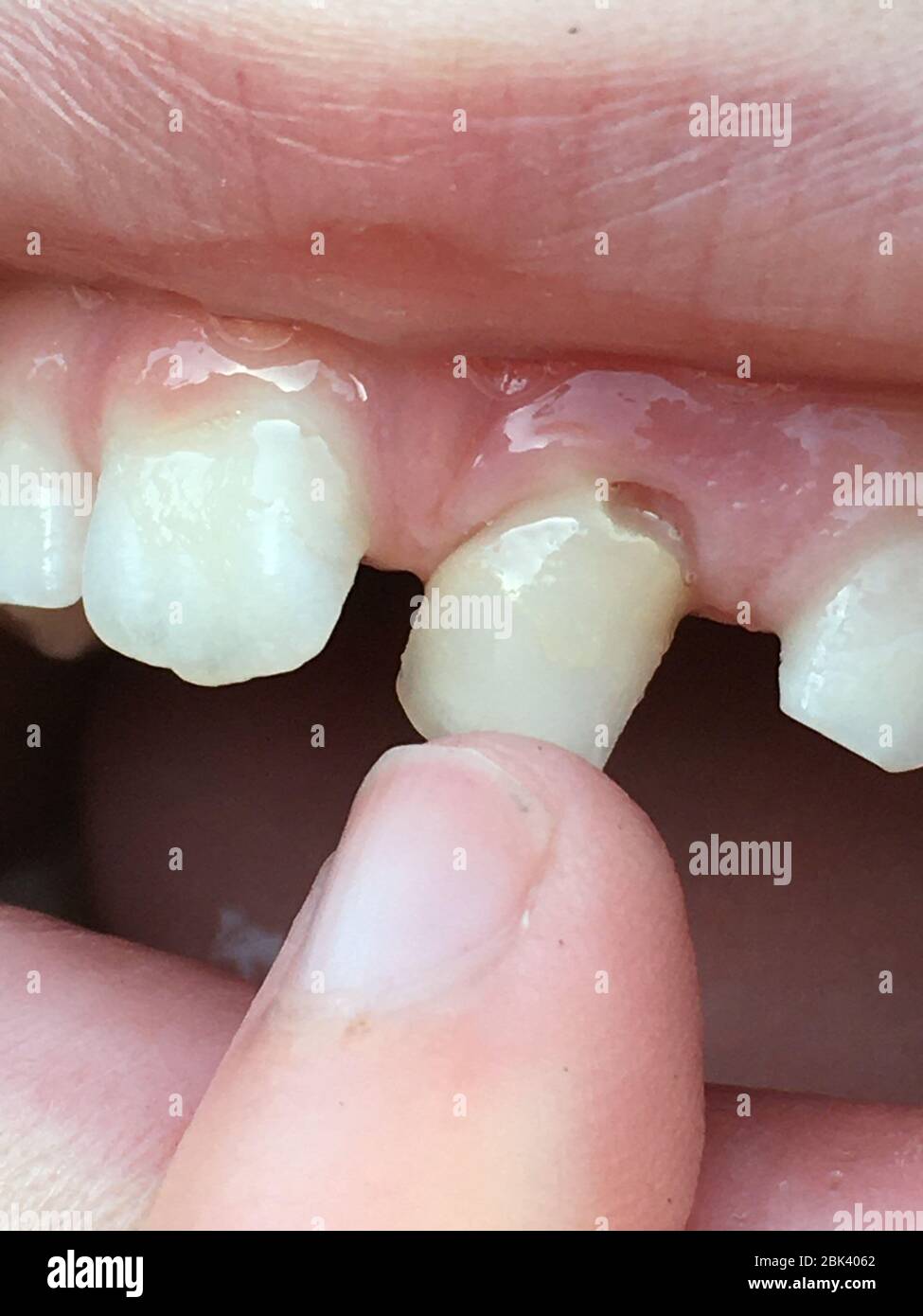 Enfant Enfant De 5 Ans Lait Avant En Vrac Dent De Bebe Dent Centrale Incisive Qui