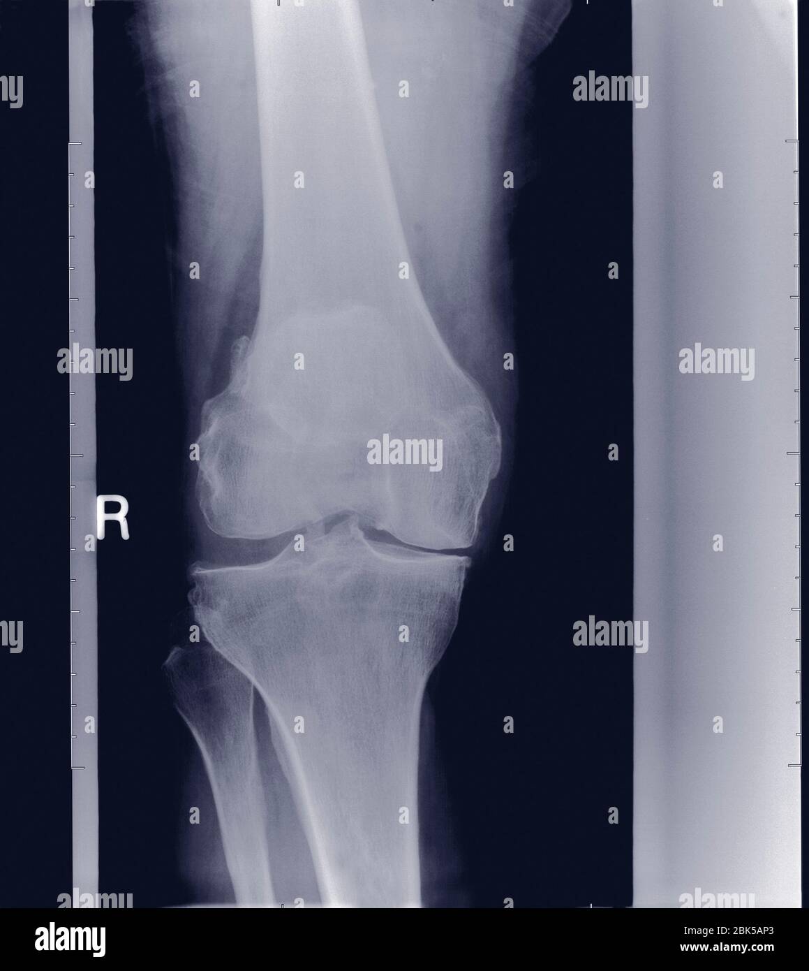Articulation du genou, radiographie. Banque D'Images