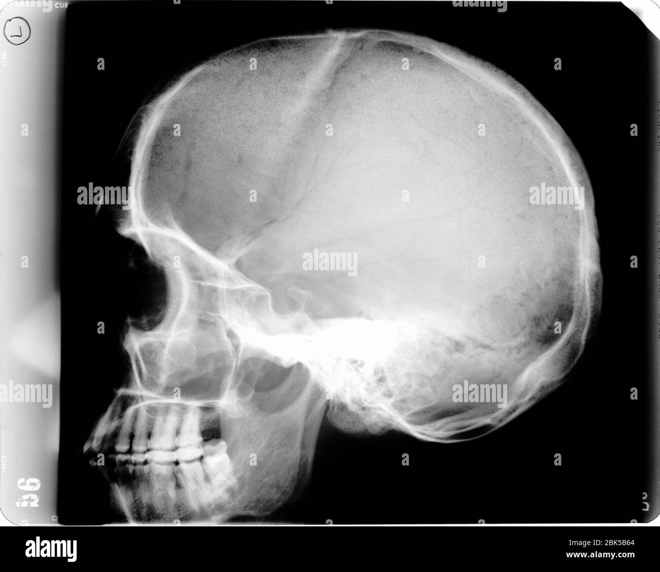 Crâne humain avec ampoule, rayons X. Banque D'Images
