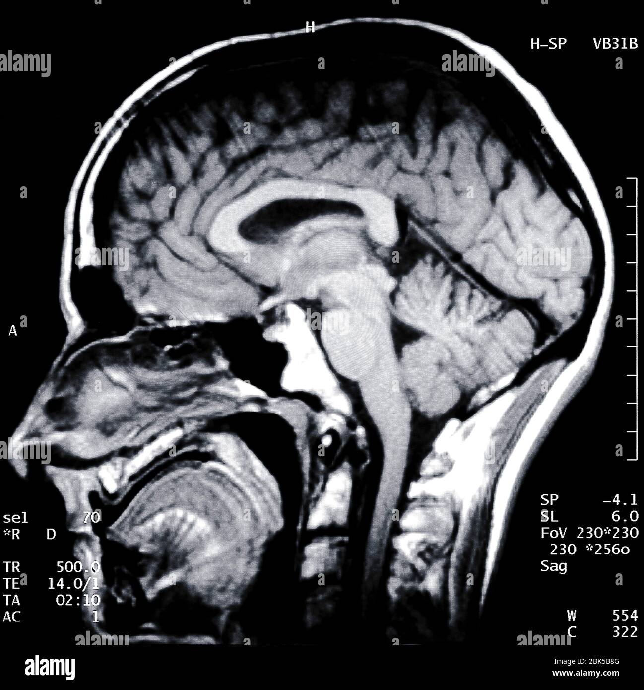 Cerveau et crâne du côté, rayons X. Banque D'Images
