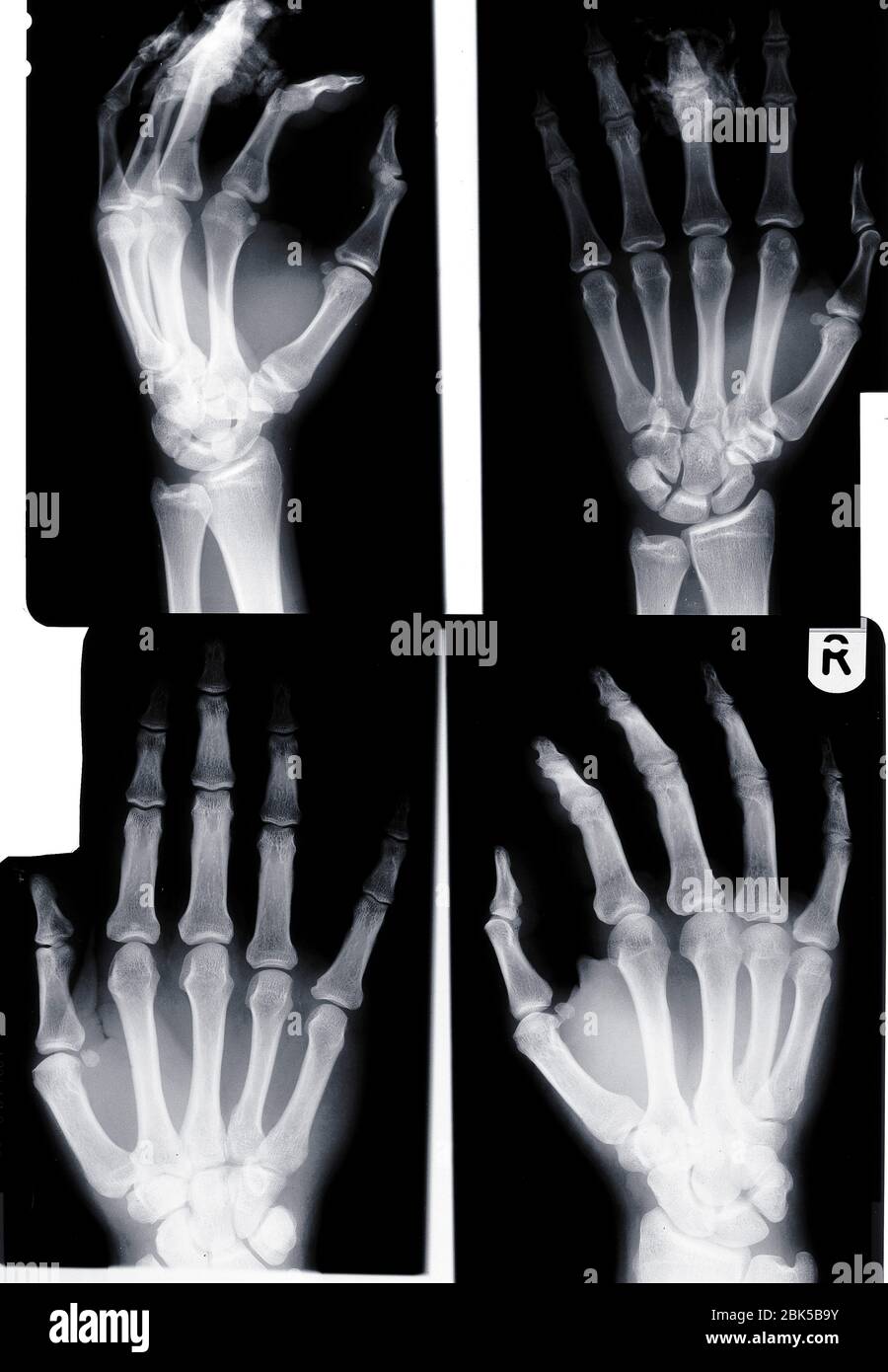 Quatre mains humaines, rayons X. Banque D'Images
