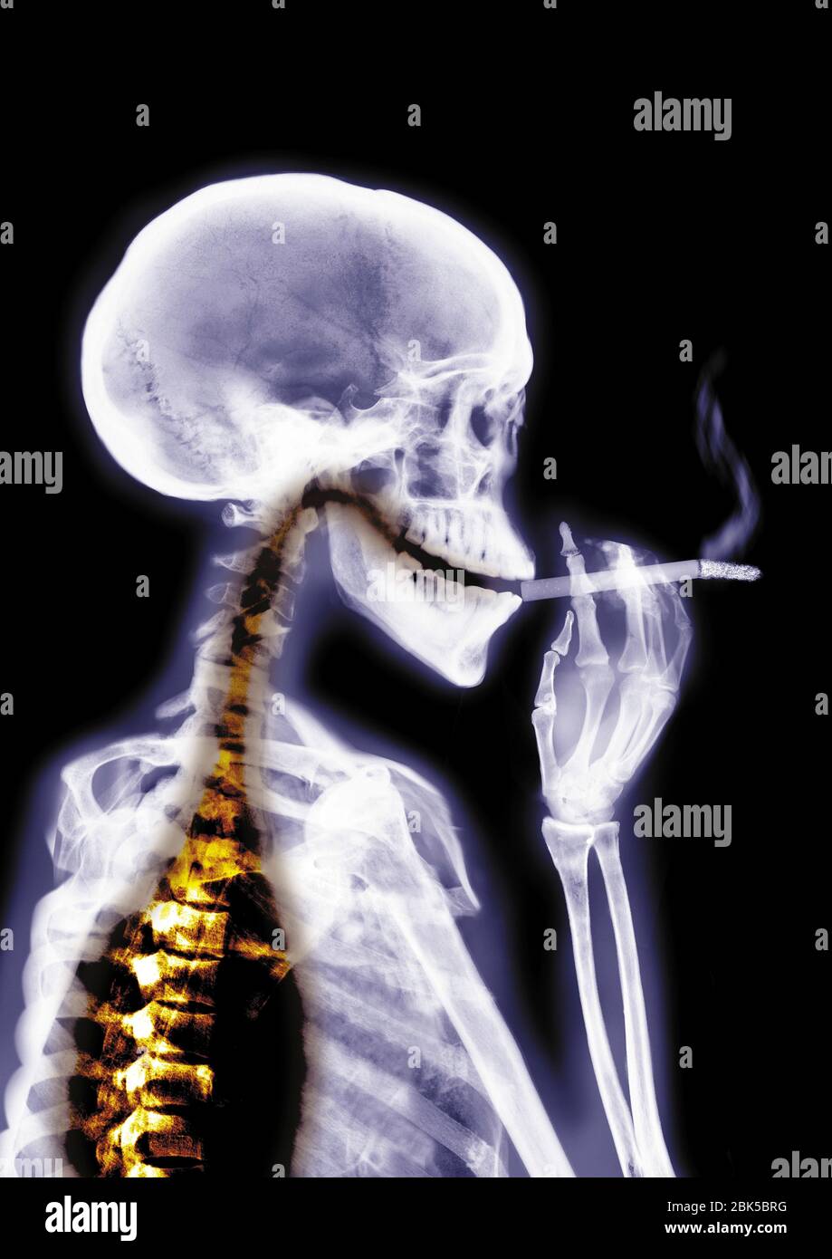Personne fumeur, radiographie colorée. Banque D'Images