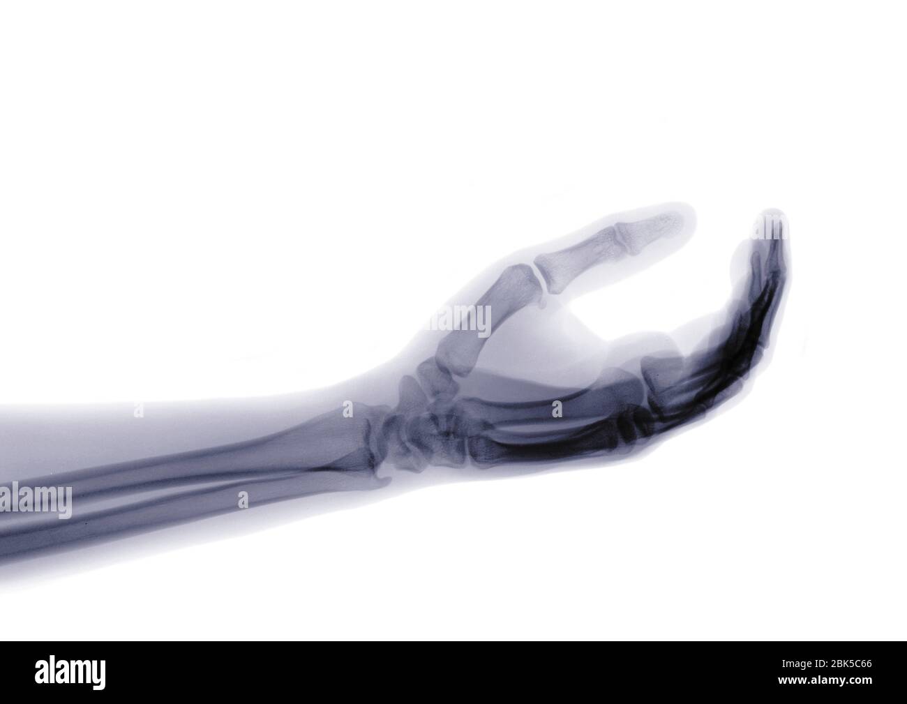 Bras et main, rayons X. Banque D'Images