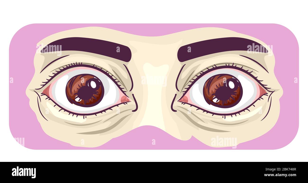Illustration des yeux renflés avec les deux yeux en saillie Banque D'Images