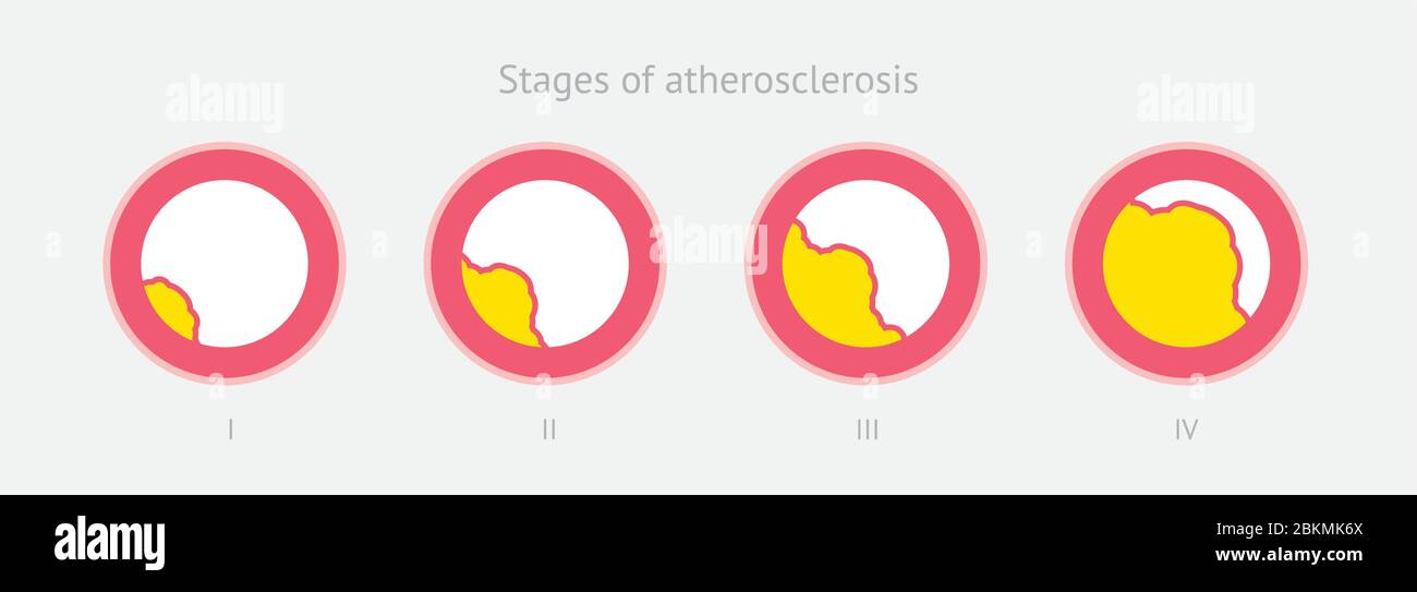 Stades de l'athérosclérose dans l'artère causée par la plaque de cholestérol Illustration de Vecteur