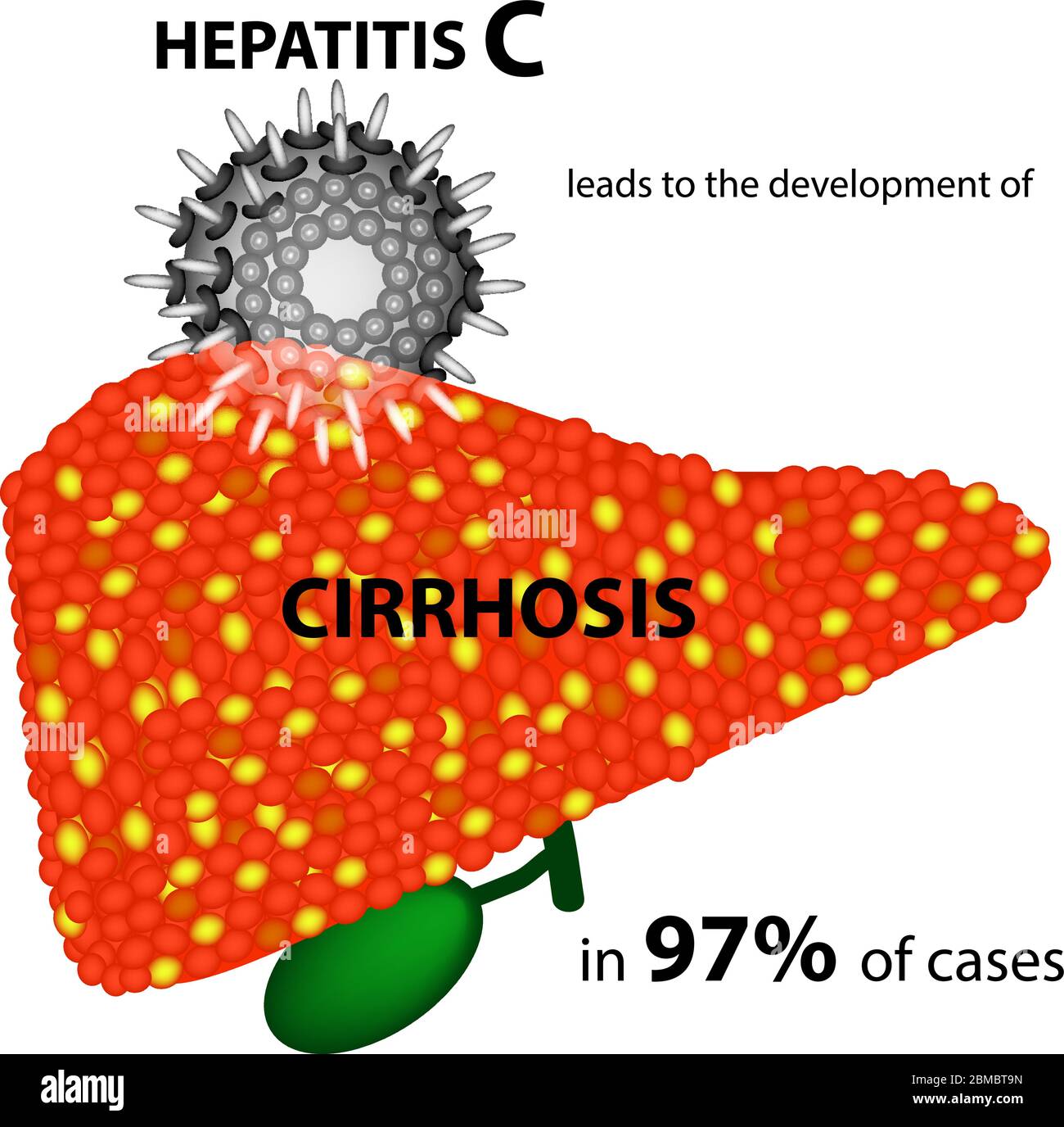 L'hépatite C entraîne le développement de la cirrhose dans 97 % des cas. Infographies. Illustration vectorielle sur un arrière-plan isolé. Illustration de Vecteur