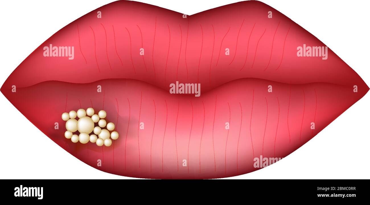 L'herpès sur la lèvre. L'infographie. Vector illustration sur fond isolé. Illustration de Vecteur