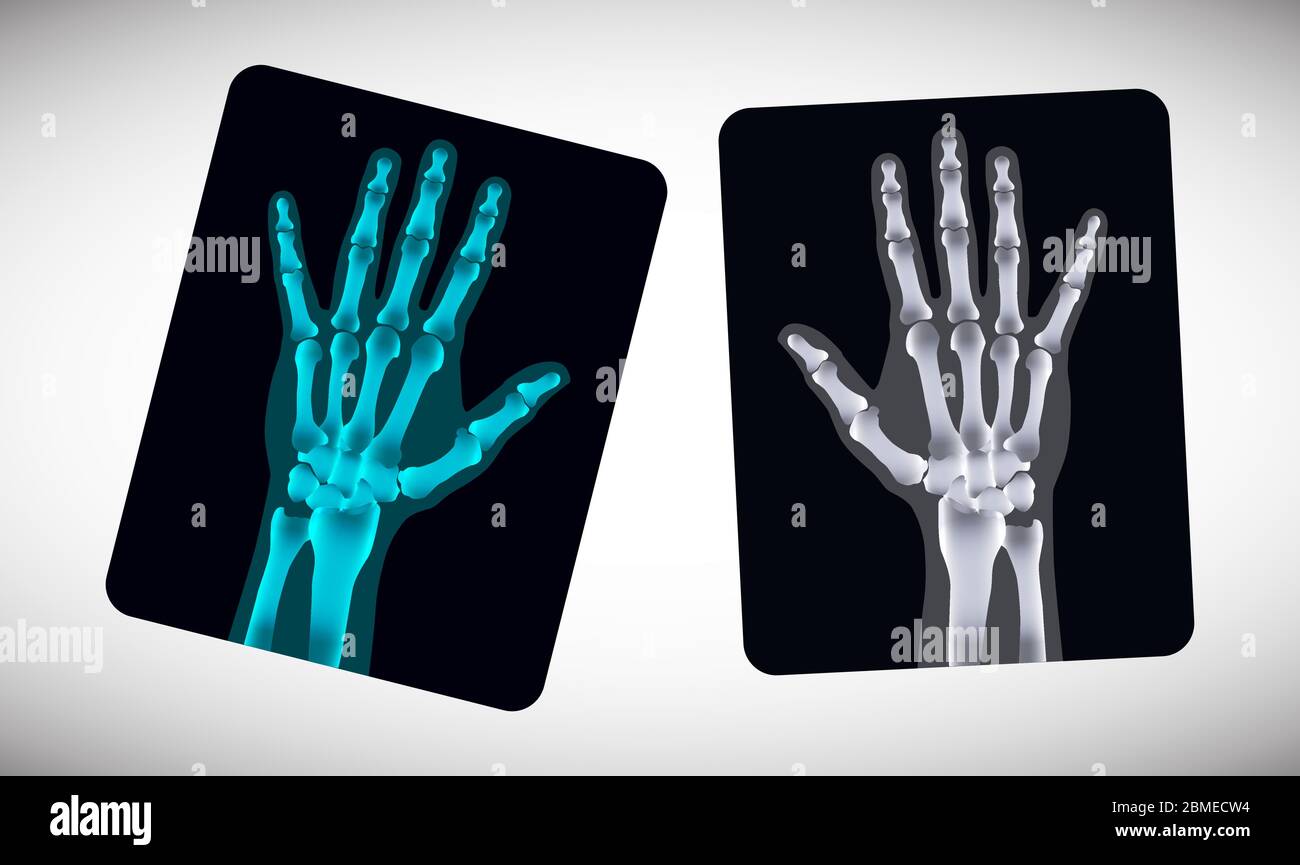 Radiographie. Photo des mains humaines sur le film. Vecteur Illustration de Vecteur