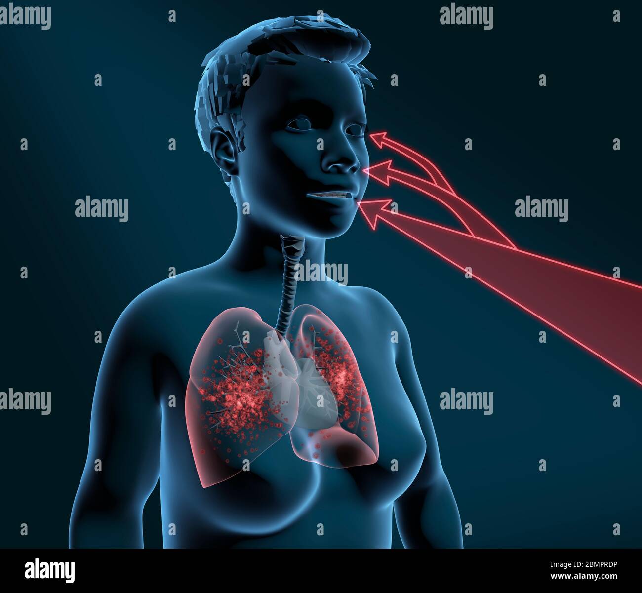 Illustration de l'ordinateur montrant les voies d'infection dans le corps et les poumons enflammés. Banque D'Images