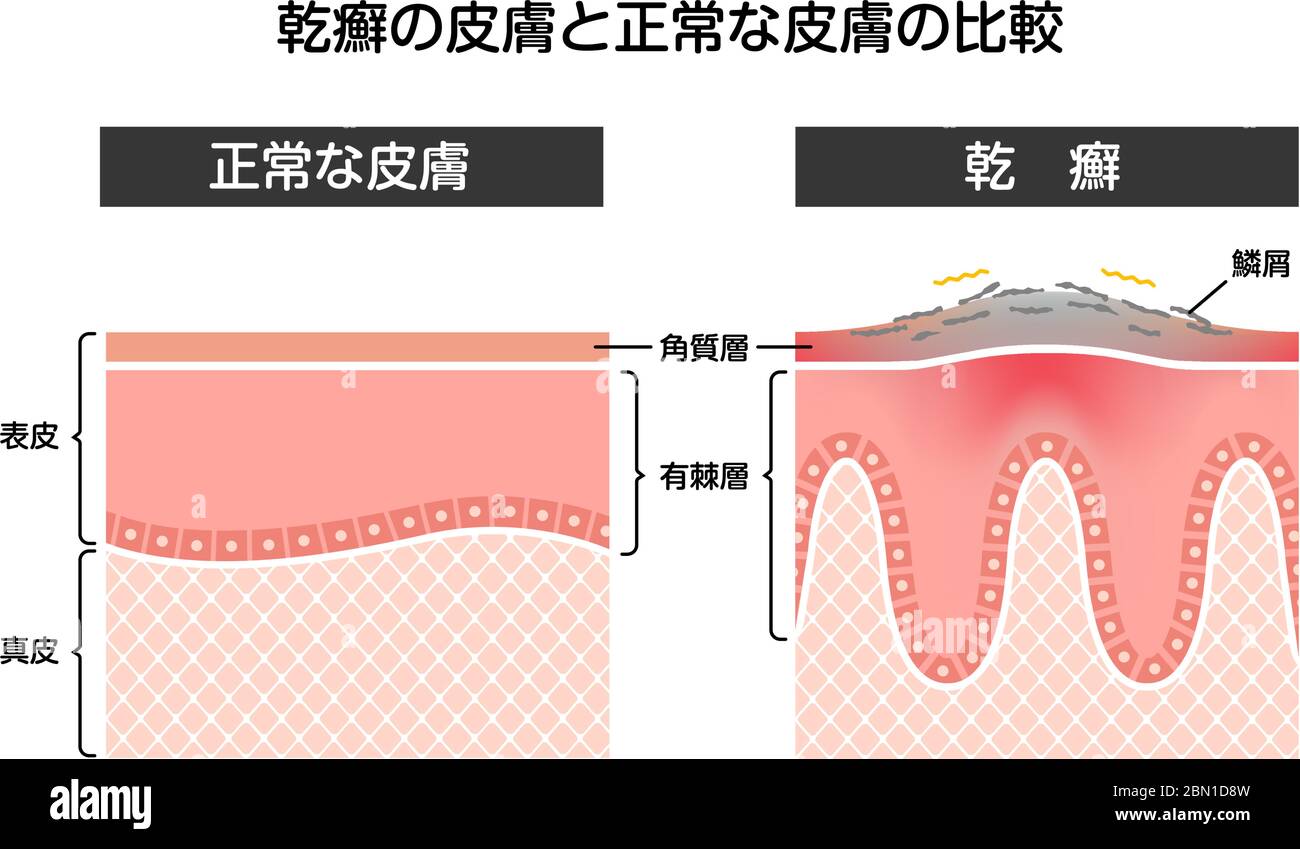 Vue en coupe du psoriasis et de la peau normale / illustration vectorielle plate (japonais) Illustration de Vecteur
