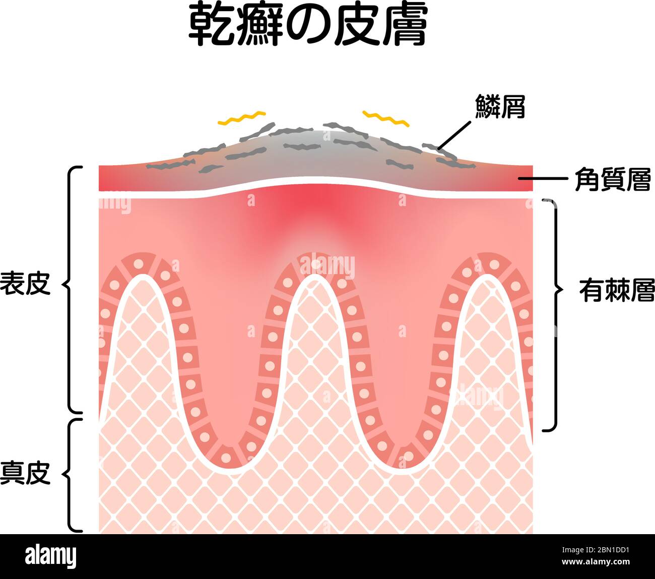 Vue en coupe de la peau du psoriasis / illustration du vecteur plat Illustration de Vecteur