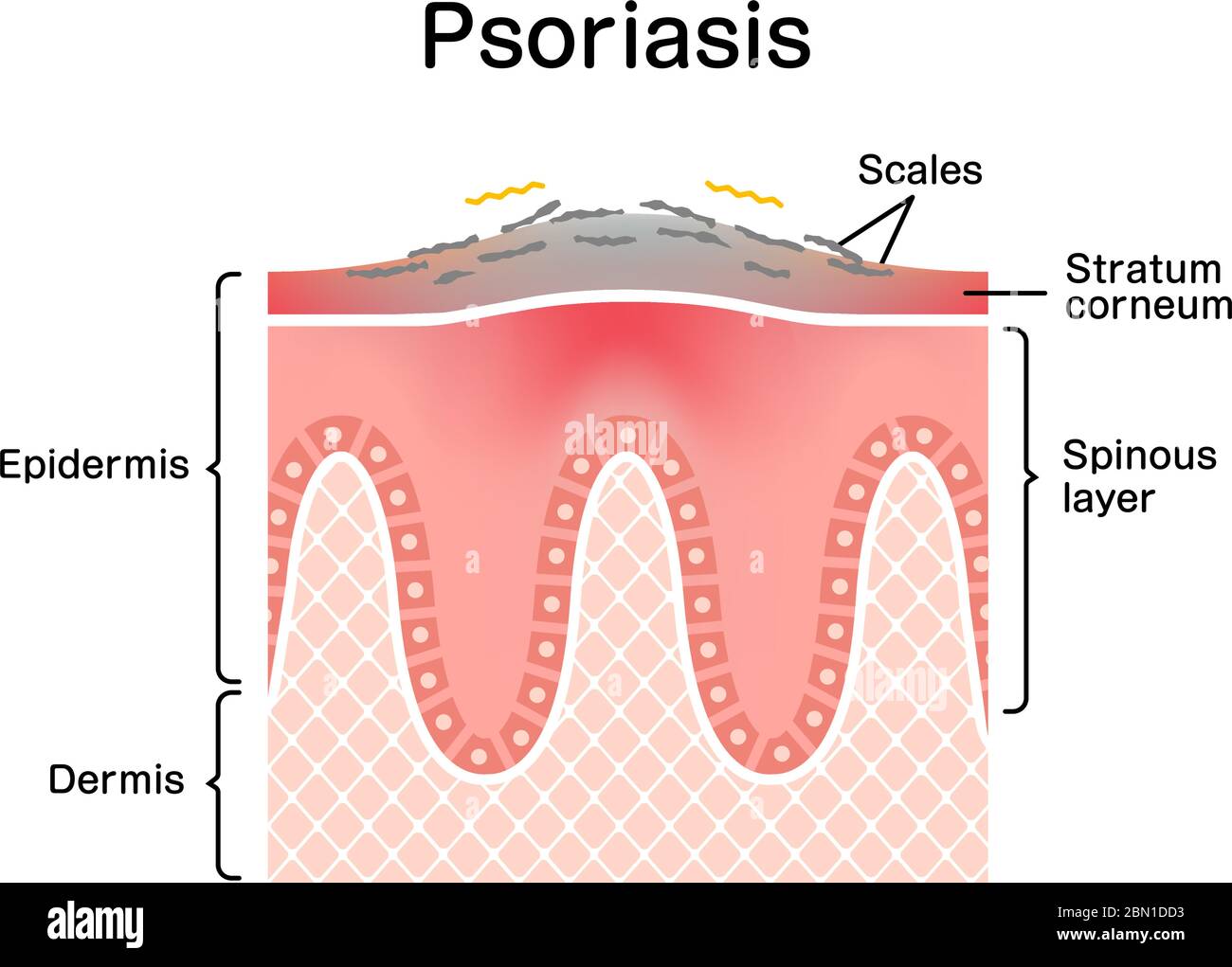 Vue en coupe de la peau du psoriasis / illustration du vecteur plat Illustration de Vecteur