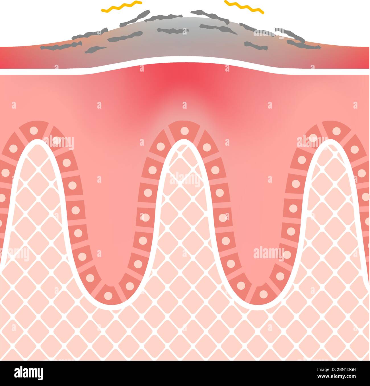 Vue en coupe de la peau du psoriasis / illustration du vecteur plat Illustration de Vecteur