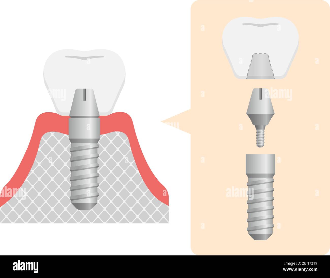 Illustration du vecteur plat de l'implant dentaire (pas de texte) Illustration de Vecteur