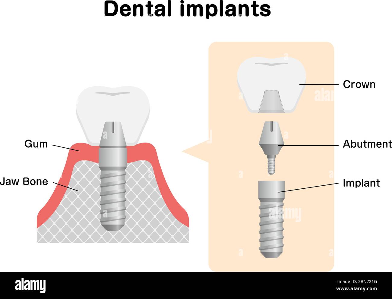 Illustration du vecteur plat de l'implant dentaire Illustration de Vecteur