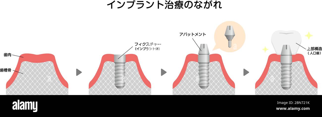Illustration du vecteur plat du processus d'implant dentaire (japonais) Illustration de Vecteur