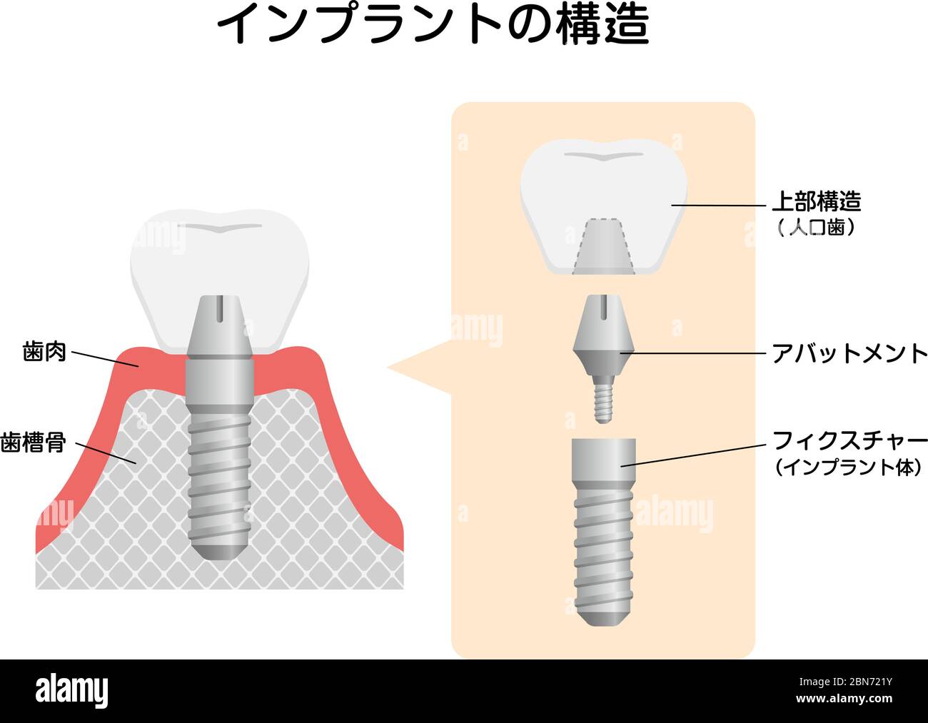 Illustration du vecteur plat de l'implant dentaire (japonais) Illustration de Vecteur