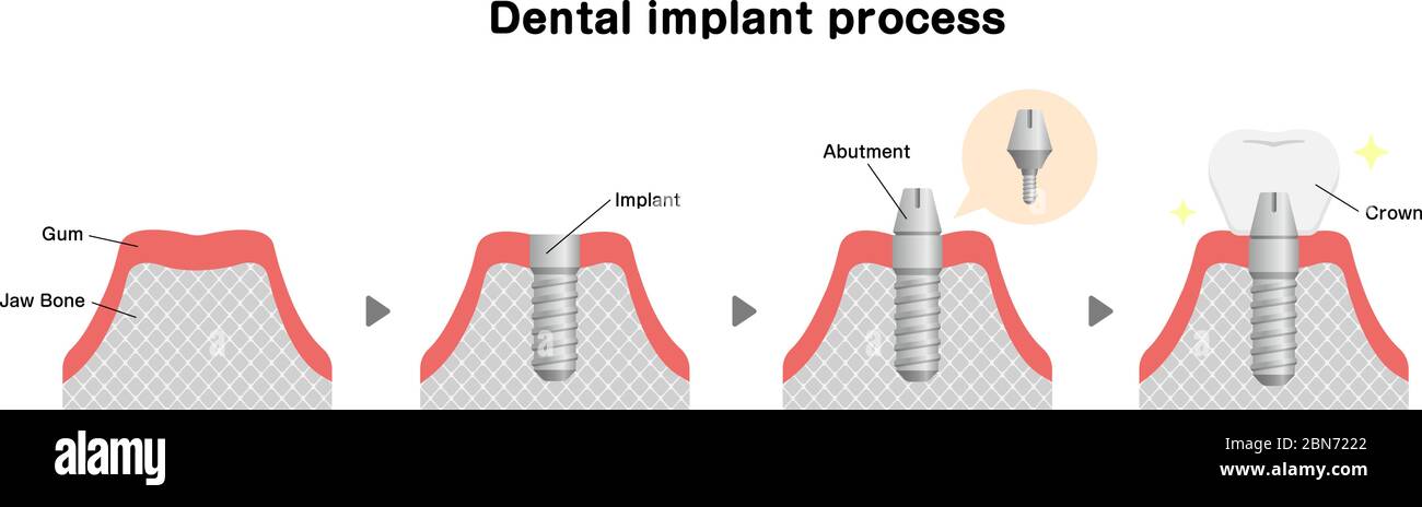 Illustration du vecteur plat du processus d'implant dentaire Illustration de Vecteur