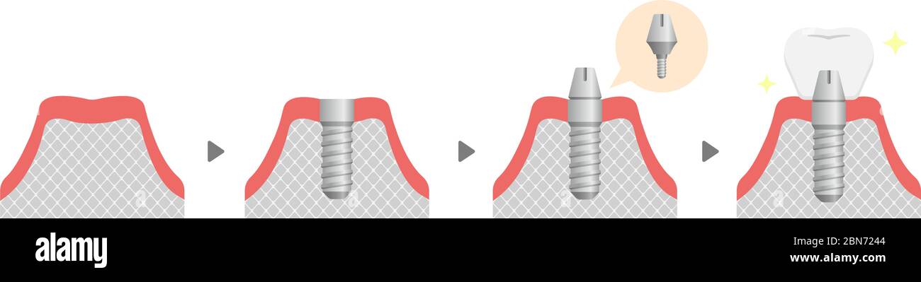 Illustration du vecteur plat du processus d'implant dentaire (pas de texte) Illustration de Vecteur