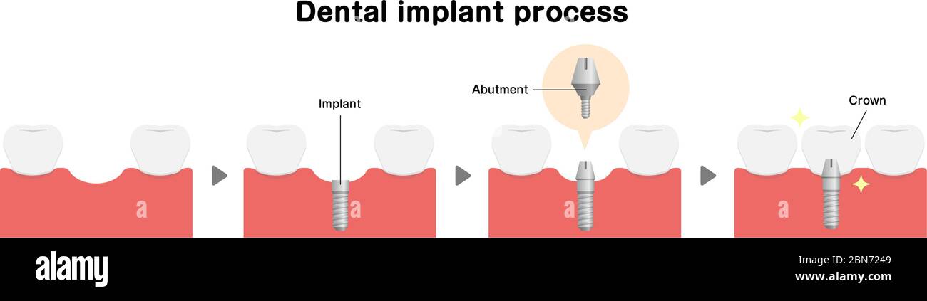 Illustration du vecteur plat du processus d'implant dentaire Illustration de Vecteur