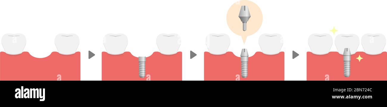 Illustration du vecteur plat du processus d'implant dentaire (pas de texte) Illustration de Vecteur