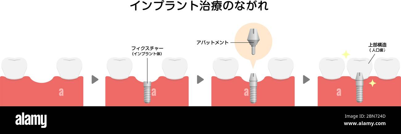 Illustration du vecteur plat du processus d'implant dentaire (japonais) Illustration de Vecteur