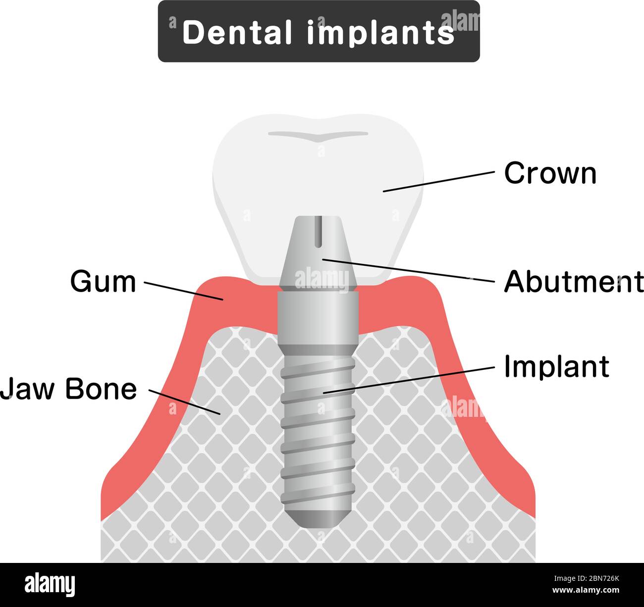 Illustration du vecteur plat de l'implant dentaire Illustration de Vecteur